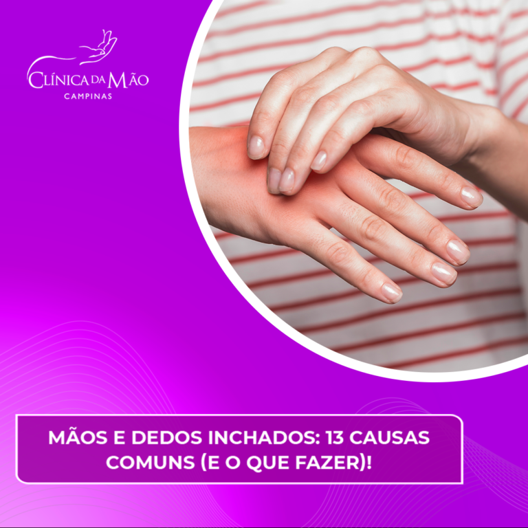 Mãos e dedos inchados: 13 causas comuns e o que fazer! - Clínica da Mão ...